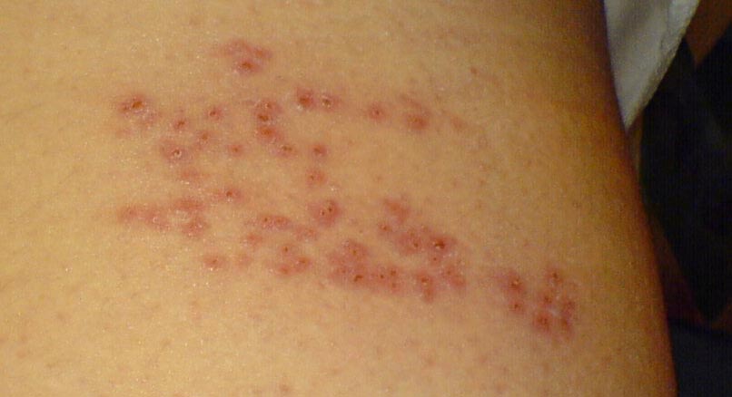 Foods to Avoid When You Have Shingles
