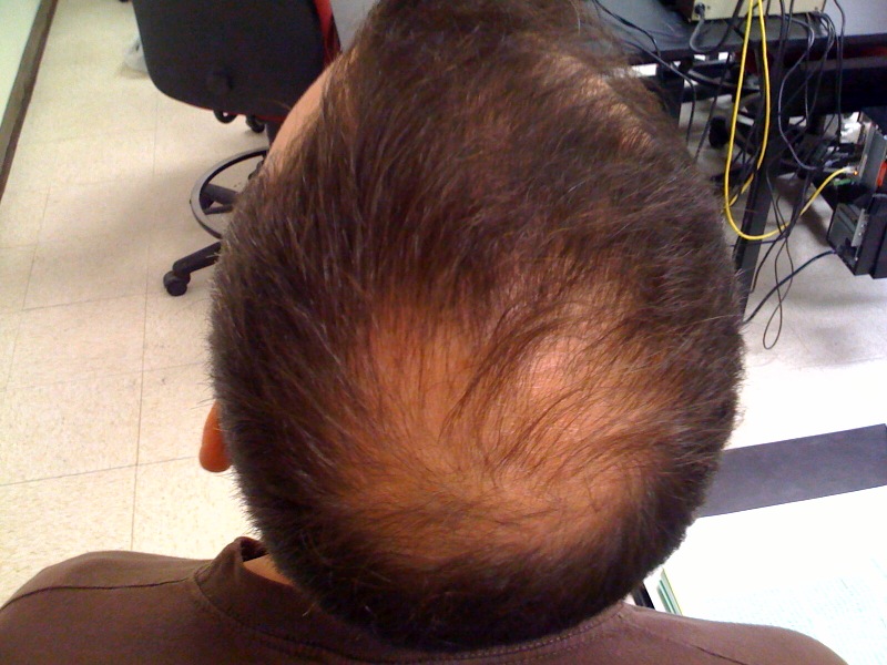 Block This Single Hormone That Causes Prostate Issues And Hair Loss